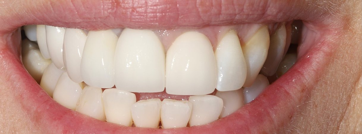 After complex restorative treatment: natural-looking new front teeth