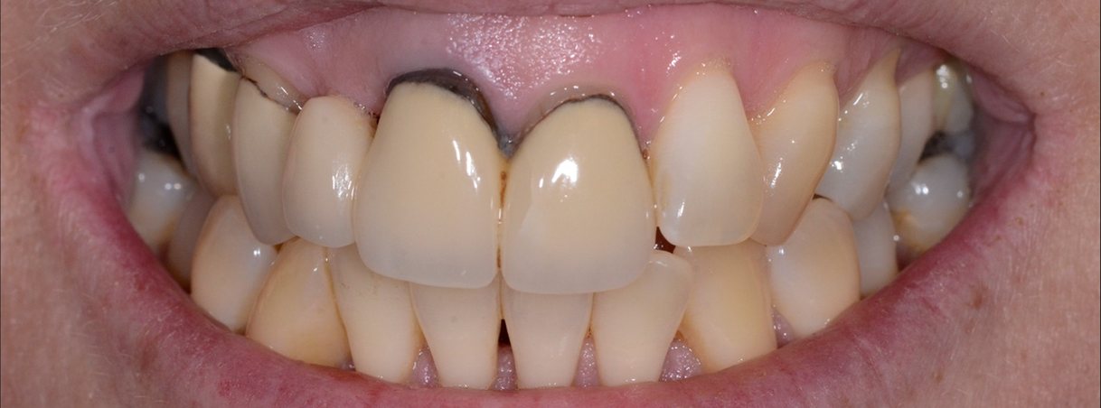 Before complex restorative treatment: old crowns with dark edges at the gum line