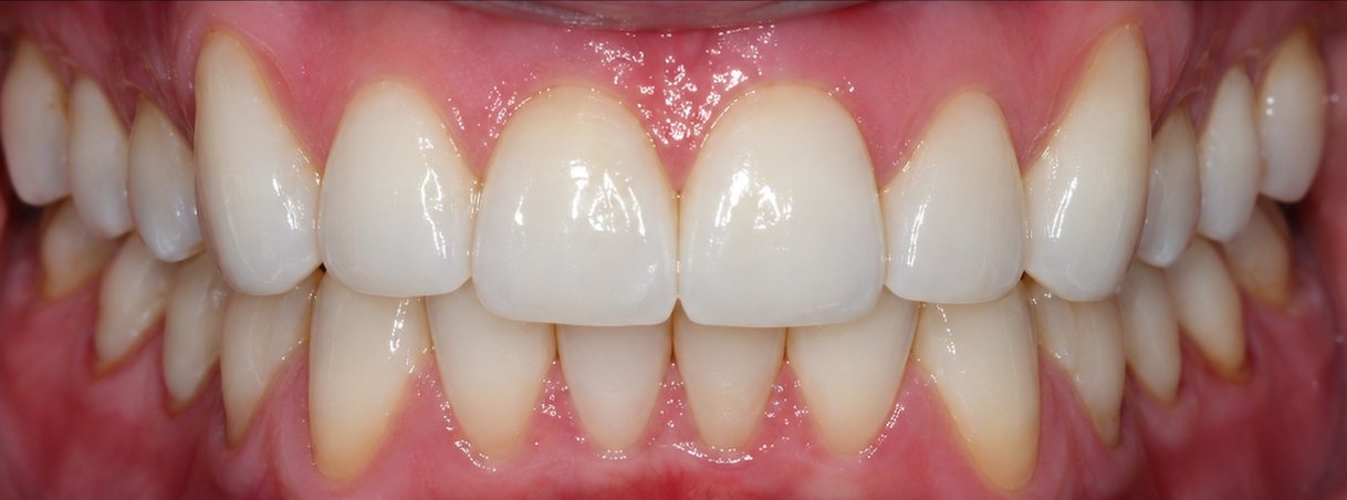 After a smile makeover: a bright, even smile