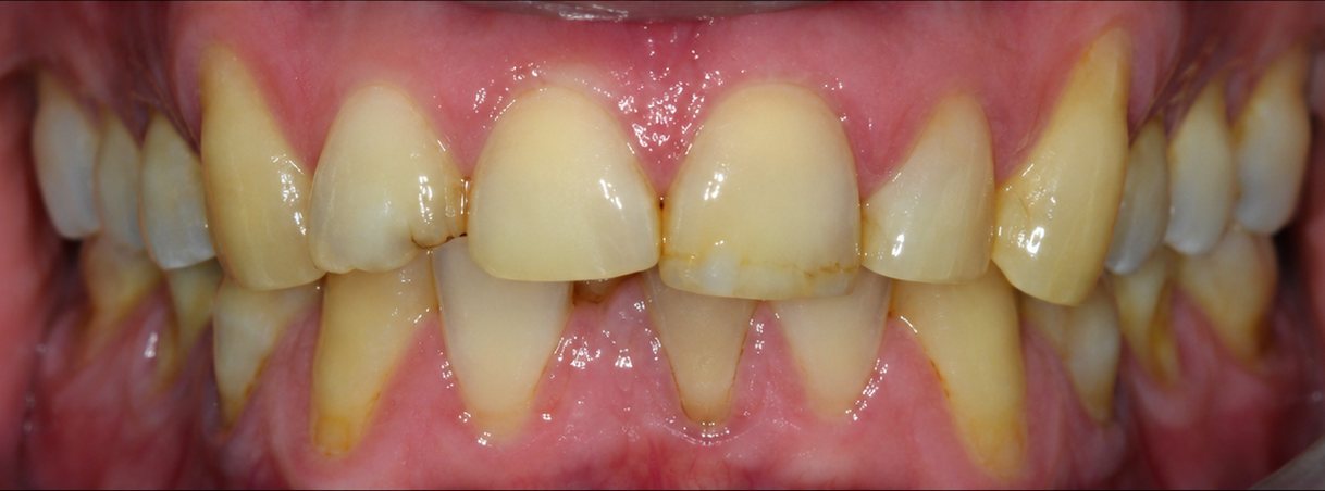 Before a smile makeover: worn and discoloured teeth