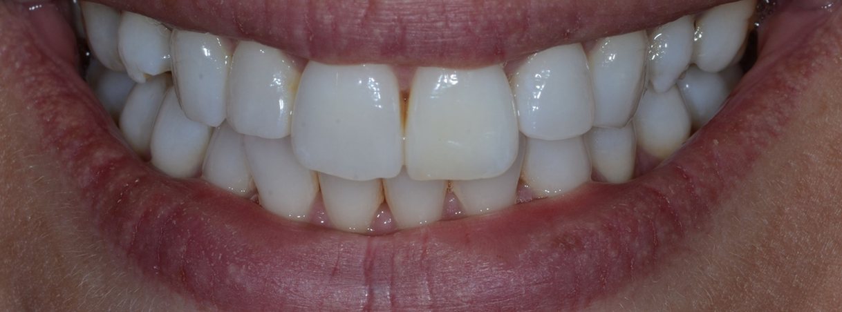 After teeth whitening: a brighter, more even shade