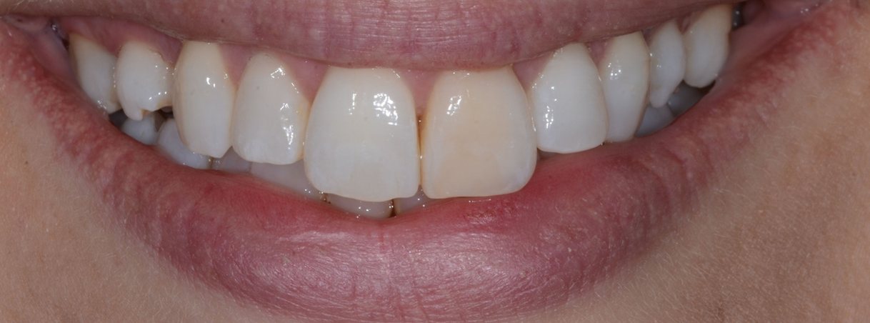 Before teeth whitening: one front tooth darker than the others