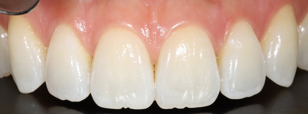 After teeth whitening: whiter, brighter front teeth