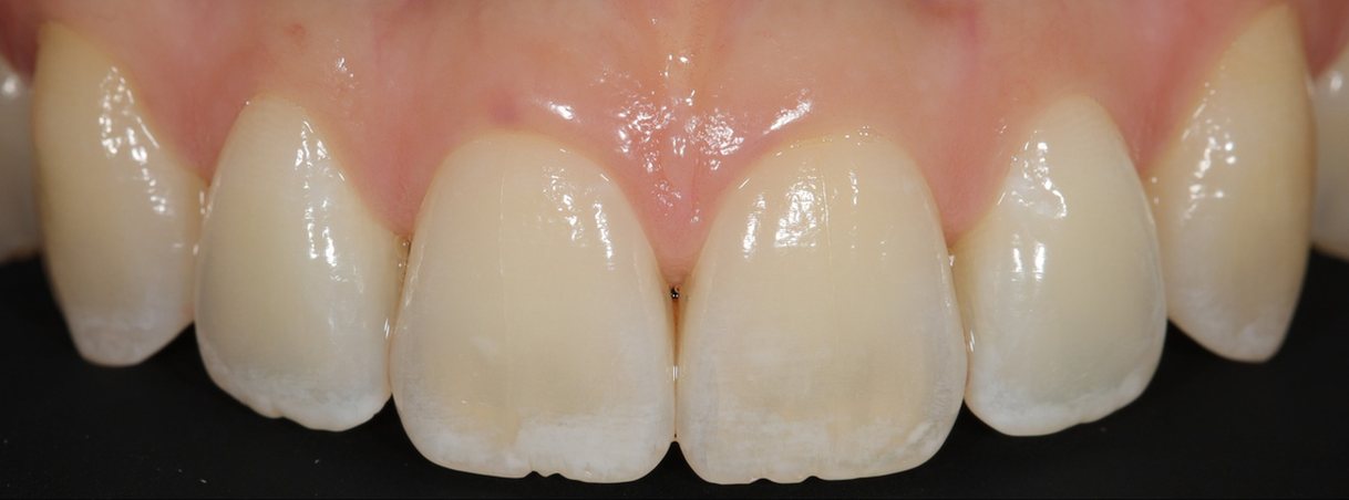 Before teeth whitening: yellow front teeth