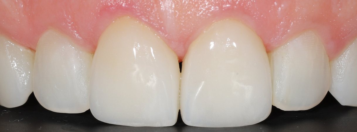 After veneers: matching front teeth with the gap closed