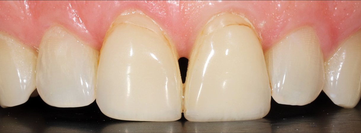 Before veneers: discoloured front teeth with a gap at the gum line
