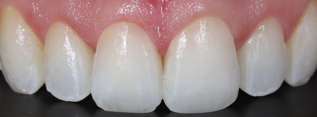 After veneers: even, bright front teeth