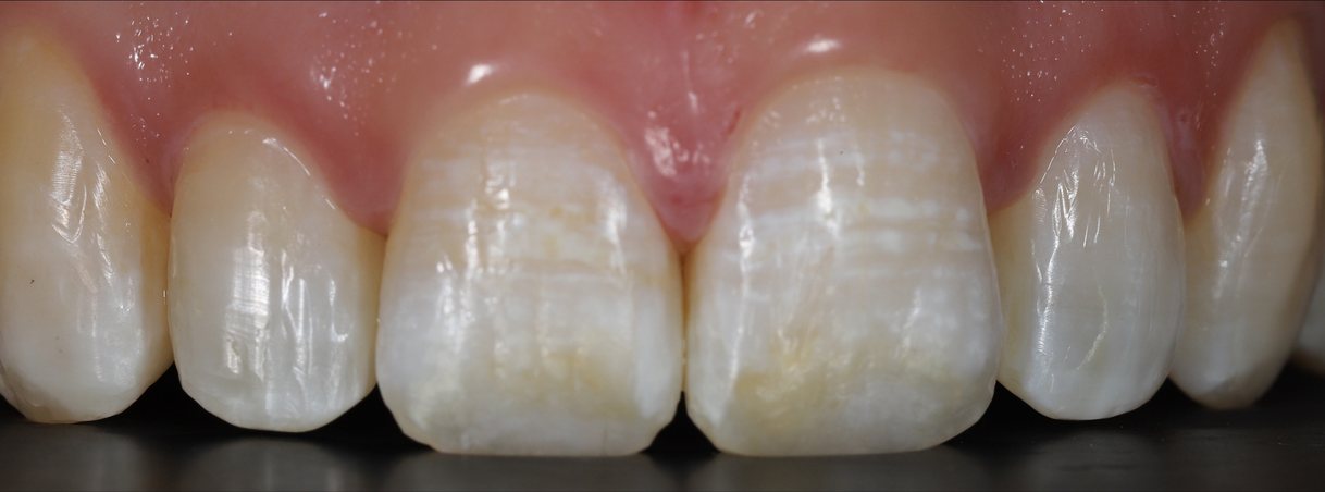 Before veneers: white and yellow streaks on the two front teeth