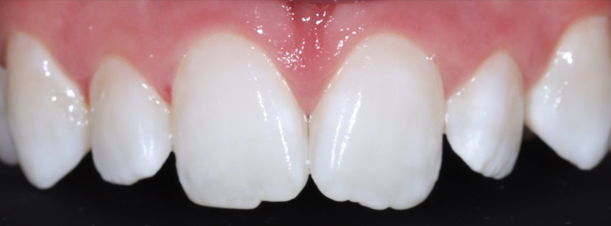 After whitening and resin infiltration: even, whiter front teeth