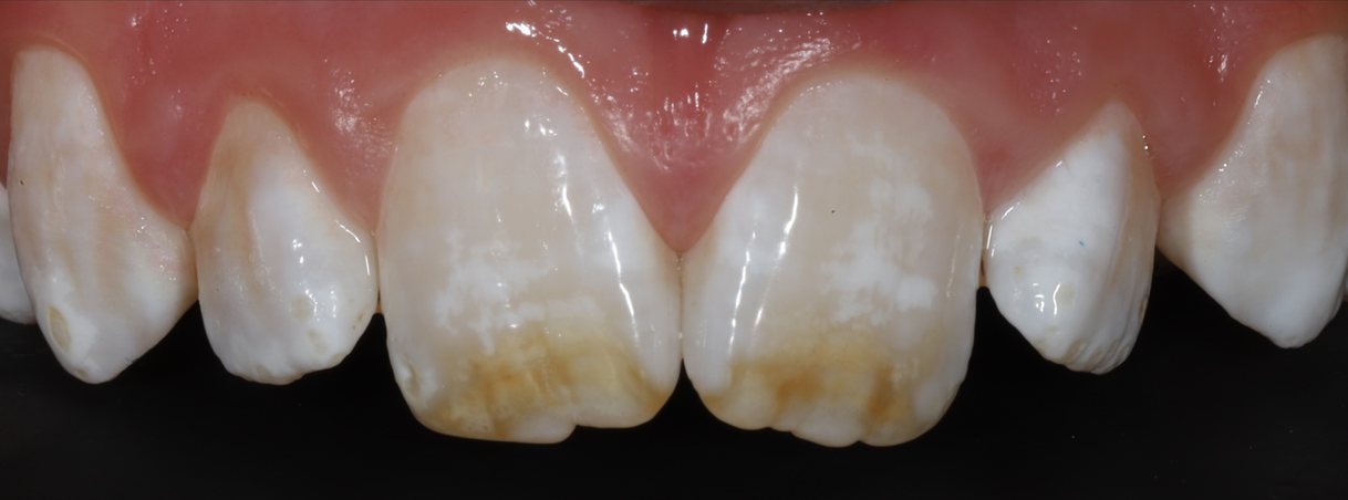 Before whitening and resin infiltration: white spots and brown staining on the front teeth